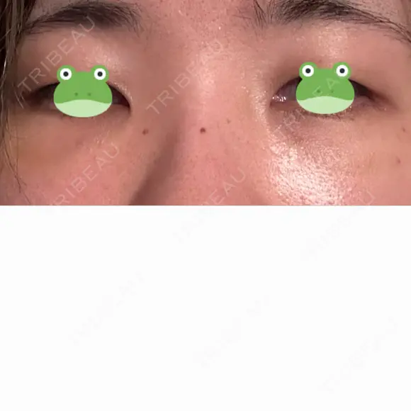 クマ治療 / 脂肪注入（肌） X CLINIC 大阪院 DAY 2 メイン用