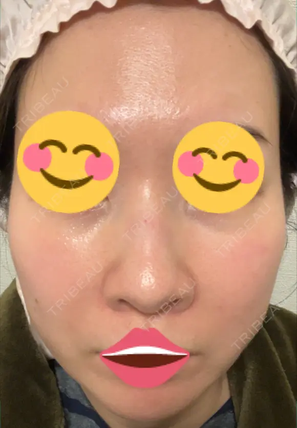ポテンツァ 9BeautyClinic DAY 5 メイン用