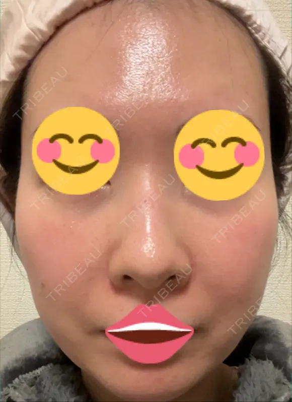 ポテンツァ 9BeautyClinic DAY 4 メイン用