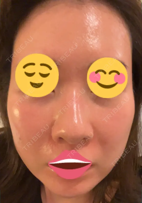 ポテンツァ 9BeautyClinic DAY 6 メイン用