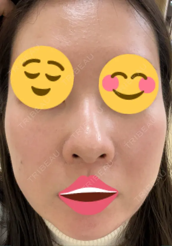ポテンツァ 9BeautyClinic DAY 6 メイン用