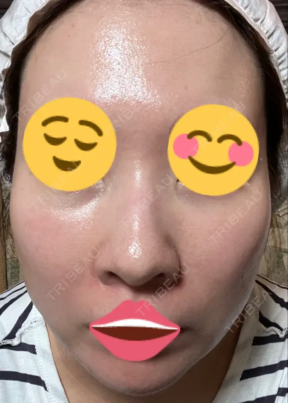 ポテンツァ 9BeautyClinic DAY 7 メイン用