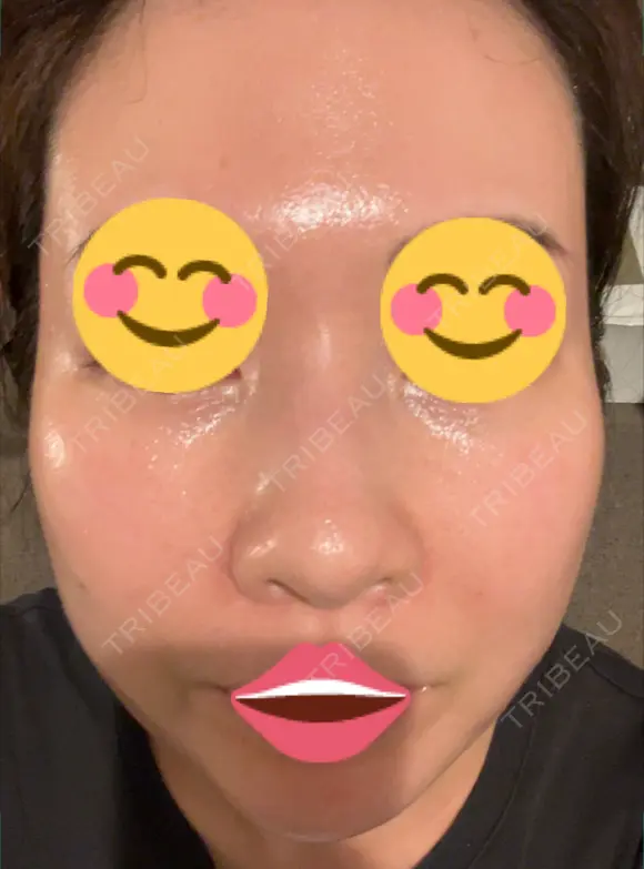 ポテンツァ 9BeautyClinic DAY 8 メイン用