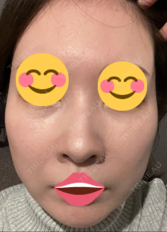 ポテンツァ 9BeautyClinic AFTER メイン用