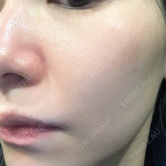 エレクトロポレーション / 毛穴洗浄（ハイドラフェイシャルなど） Re：HADA CLINIC 銀座 DAY 0 メイン用