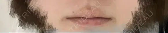 シミ取りレーザー Jスキンクリニック 【J-SKIN clinic】 AFTER メイン用