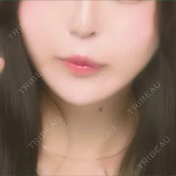 肌ヒアルロン酸注入（たるみ・シワ改善） / ヒアルロン酸注入（唇） TCB東京中央美容外科 中野院 DAY 0 メイン用