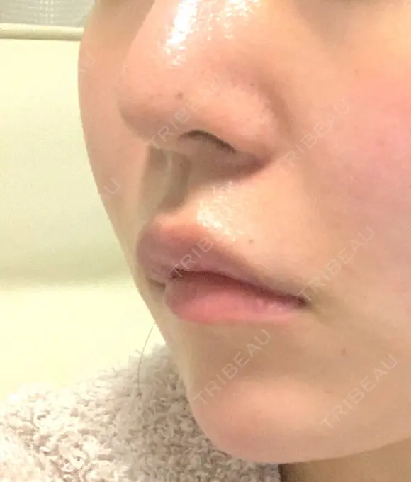 肌ヒアルロン酸注入（たるみ・シワ改善） / ヒアルロン酸注入（唇） TCB東京中央美容外科 中野院 DAY 2 メイン用