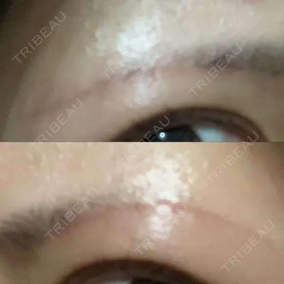 眉下切開 湘南美容クリニック 赤羽院 DAY 100 メイン用