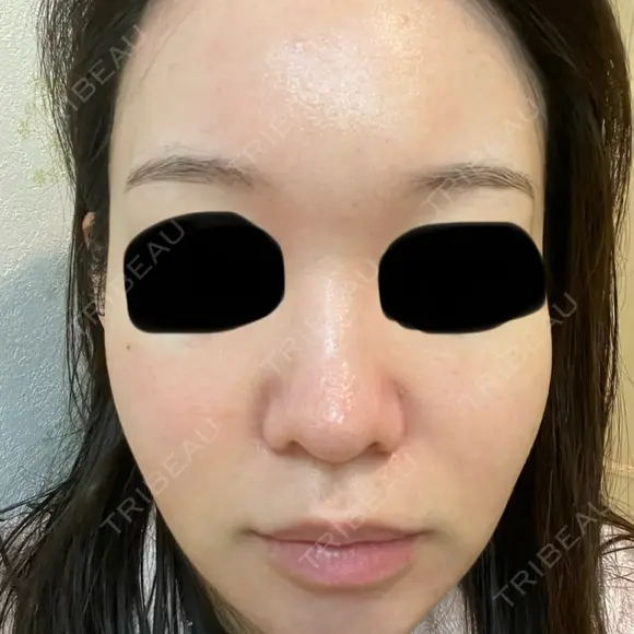 イオン導入 / 毛穴洗浄（ハイドラフェイシャルなど） oneUPclinic DAY 1 メイン用