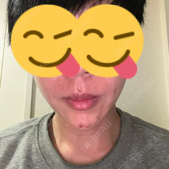 ボトックス（あご） / ヒアルロン酸注入（あご） / ヒアルロン酸注入（鼻翼基部） シェリークリニック 新宿本院 AFTER メイン用