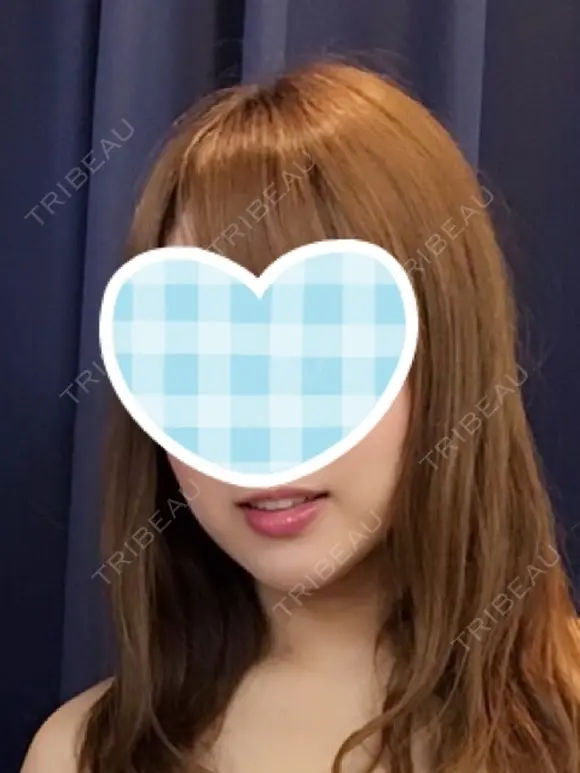 ヒアルロン酸注入（あご） 加藤クリニック麻布 大阪院 DAY 33 メイン用