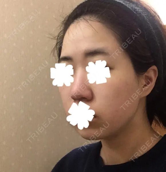 鼻尖形成（切開） / 小鼻縮小（切開） / その他（鼻） / 軟骨移植 JUN CLINIC AFTER メイン用