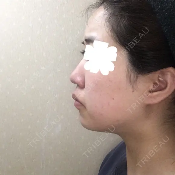鼻尖形成（切開） / 小鼻縮小（切開） / その他（鼻） / 軟骨移植 JUN CLINIC DAY 61 メイン用