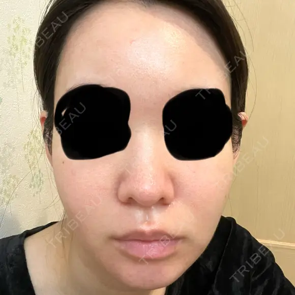 イオン導入 / 毛穴洗浄（ハイドラフェイシャルなど） oneUPclinic DAY 3 メイン用