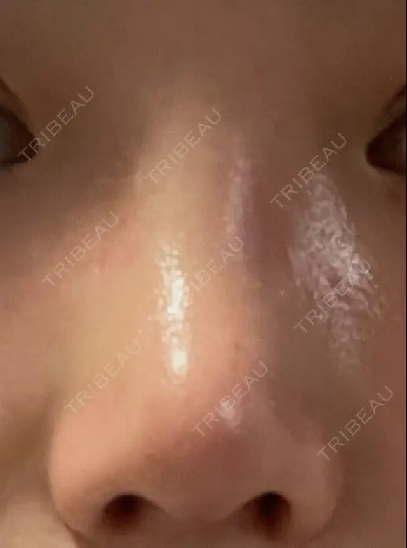 鼻尖形成（切開） / 軟骨移植 / 鼻修正 / 鼻柱下降・鼻唇角形成（猫手術） 東京シンデレラ美容外科 池袋院 DAY 46 メイン用