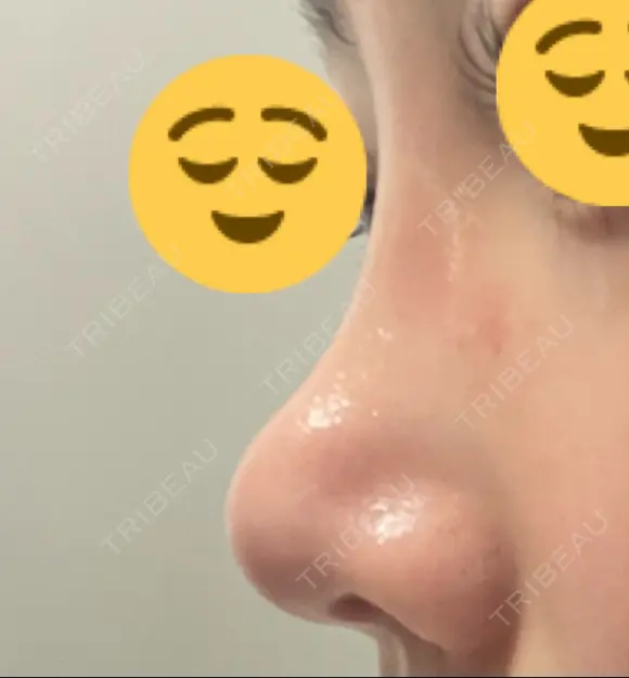 鼻尖形成（切開） / 軟骨移植 / 鼻修正 / 鼻柱下降・鼻唇角形成（猫手術） 東京シンデレラ美容外科 池袋院 DAY 46 メイン用