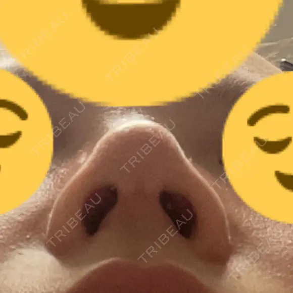 鼻尖形成（切開） / 軟骨移植 / 鼻修正 / 鼻柱下降・鼻唇角形成（猫手術） 東京シンデレラ美容外科 池袋院 DAY 46 メイン用