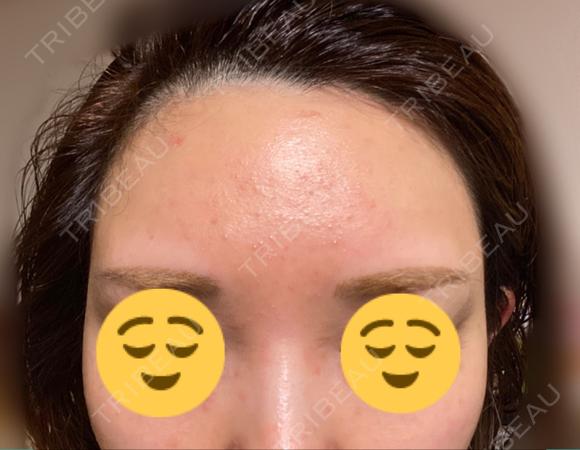ピーリング（ニキビ・毛穴） / イオン導入 OMI CLINIC 【オミクリニック】 DAY 1 メイン用
