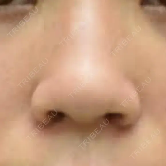 小鼻縮小（切開） 渋谷の森クリニック DAY 7 メイン用