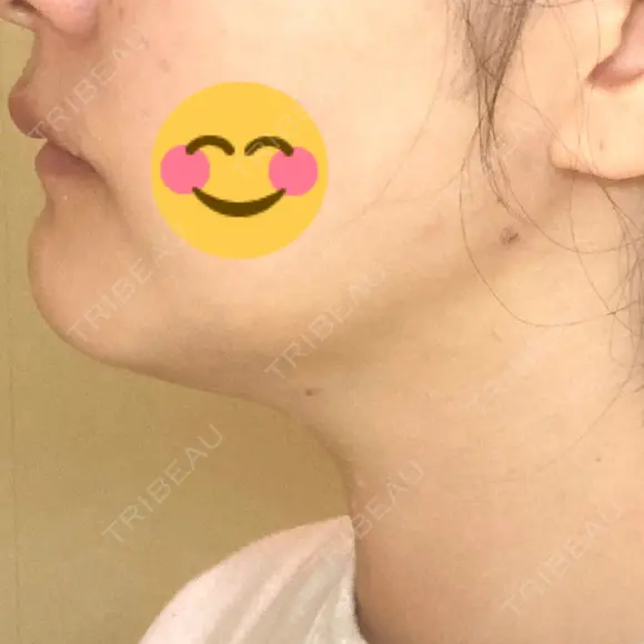 脂肪吸引（顔） / 脂肪吸引注射（顔） ziz CLINIC DAY 6 メイン用