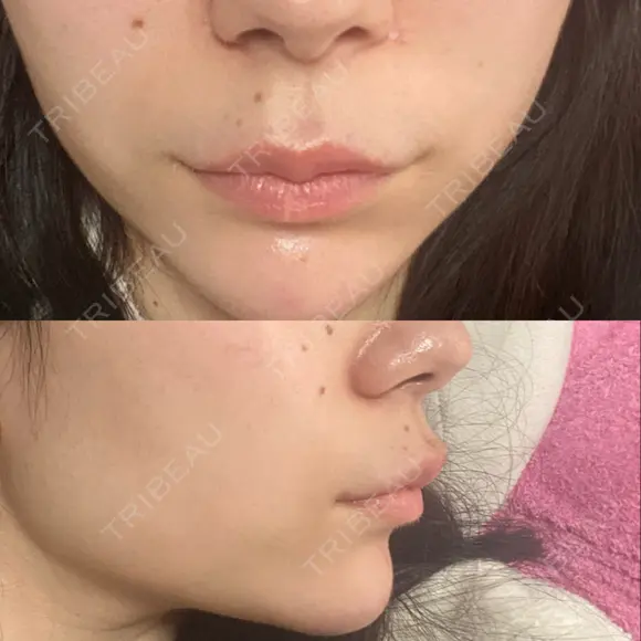 ボトックス（人中） Taide Suenaga Clinic（タイデスエナガクリニック） DAY 0 メイン用