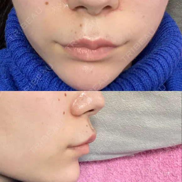 ボトックス（人中） Taide Suenaga Clinic（タイデスエナガクリニック） DAY 1 メイン用