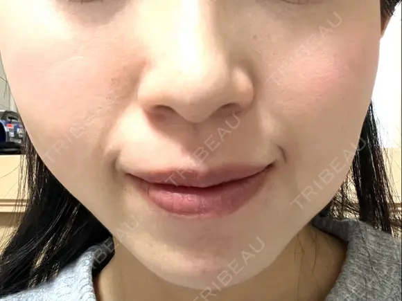 ボトックス（口角） ルラ美容クリニック 名古屋本院 DAY 3 メイン用