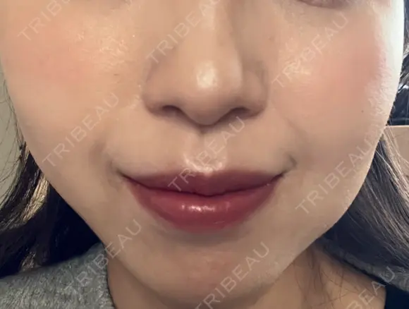 ボトックス（口角） ルラ美容クリニック 名古屋本院 DAY 4 メイン用