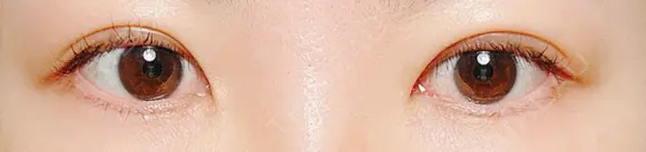 二重埋没 水の森美容クリニック 東京銀座院 AFTER メイン用