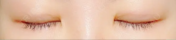 二重埋没 水の森美容クリニック 東京銀座院 DAY 44 メイン用