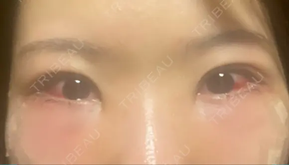 クマ治療 / 下まぶたたるみ取り / 目元修正 / 脂肪注入（目の下） / その他（目元） 吉井クリニック DAY 2 メイン用