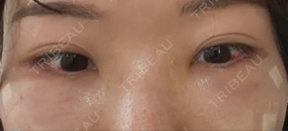 クマ治療 / 下まぶたたるみ取り / 目元修正 / 脂肪注入（目の下） / その他（目元） 吉井クリニック DAY 3 メイン用