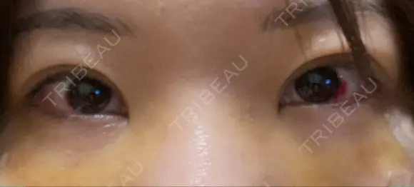 クマ治療 / 下まぶたたるみ取り / 目元修正 / 脂肪注入（目の下） / その他（目元） 吉井クリニック DAY 4 メイン用