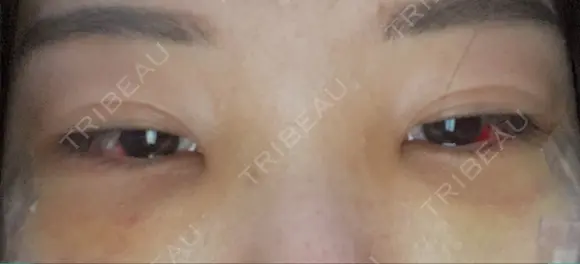 クマ治療 / 下まぶたたるみ取り / 目元修正 / 脂肪注入（目の下） / その他（目元） 吉井クリニック DAY 5 メイン用