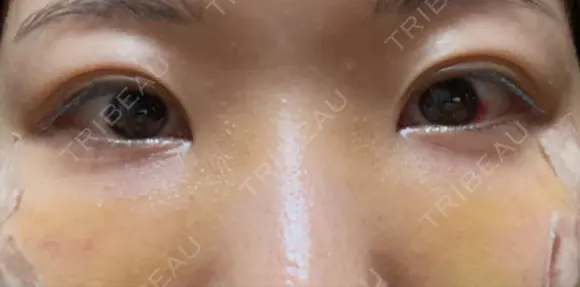 クマ治療 / 下まぶたたるみ取り / 目元修正 / 脂肪注入（目の下） / その他（目元） 吉井クリニック DAY 8 メイン用