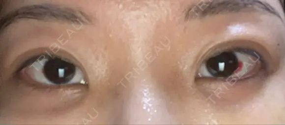 クマ治療 / 下まぶたたるみ取り / 目元修正 / 脂肪注入（目の下） / その他（目元） 吉井クリニック DAY 15 メイン用