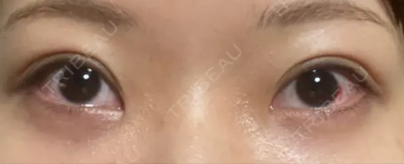 クマ治療 / 下まぶたたるみ取り / 目元修正 / 脂肪注入（目の下） / その他（目元） 吉井クリニック DAY 24 メイン用