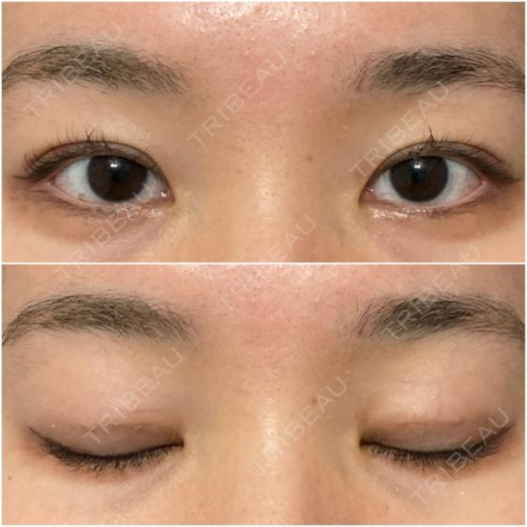 二重埋没 オアシス美容外科 DAY 16 メイン用