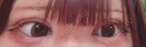 二重切開 / 目頭切開 / 眼瞼下垂（切開） オーキッド美容クリニック東京御徒町 DAY 9 メイン用