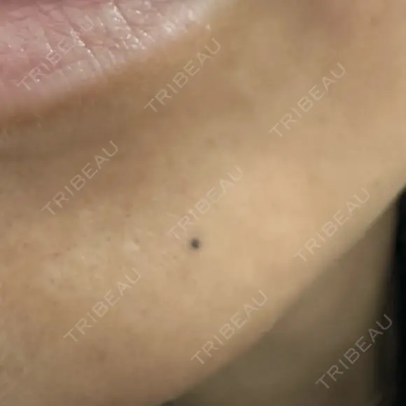 アートメイク（ほくろ） 新宿クレアクリニック AFTER メイン用