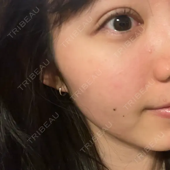 ピーリング（ニキビ・毛穴） / イオン導入 渋谷美容外科クリニック 横浜院 AFTER メイン用