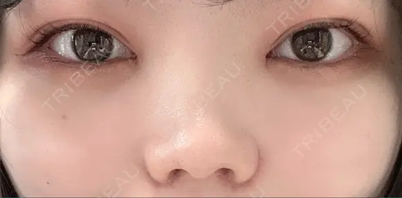 二重埋没 / 目頭切開 / 鼻尖形成（切開） / 軟骨移植 / 眉間プロテーゼ / 鼻尖縮小 グローバルビューティークリニック 大阪院 DAY 17 メイン用