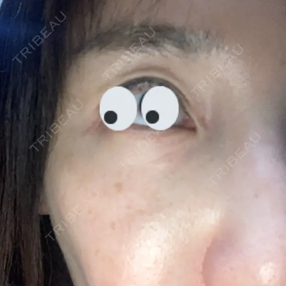 ベビーコラーゲン / サーマクール 新宿ラクル美容外科クリニック 新宿院 DAY 0 メイン用