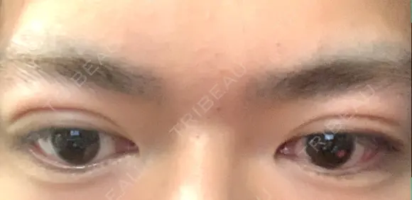 二重埋没 藤・ナチュレ美容クリニック 銀座院 DAY 12 メイン用