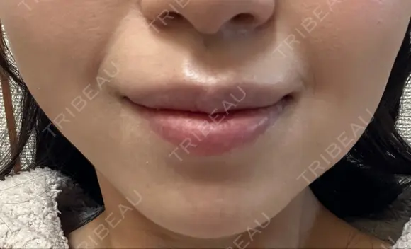 ボトックス（口角） ルラ美容クリニック 名古屋本院 DAY 5 メイン用