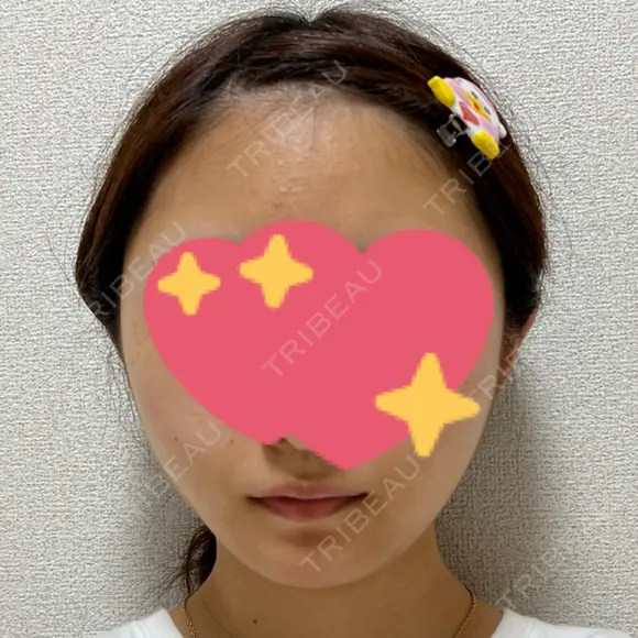 糸リフト / ボトックス（エラ・小顔） TCB東京中央美容外科 仙台駅前院 DAY 0 メイン用