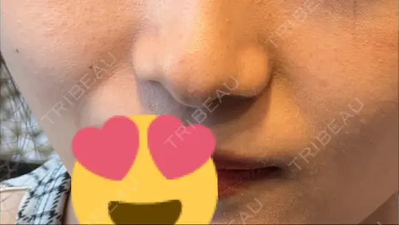 糸リフト / ボトックス（エラ・小顔） TCB東京中央美容外科 仙台駅前院 DAY 2 メイン用