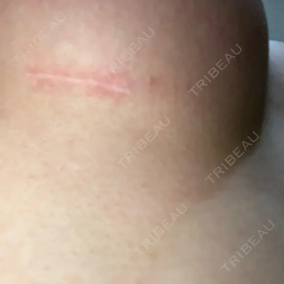 豊胸（シリコン＋脂肪併用） Casa de GRACIA GINZA 【カーサデグラシアギンザ】 DAY 181 メイン用