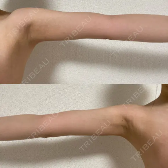 豊胸（シリコン＋脂肪併用） Casa de GRACIA GINZA 【カーサデグラシアギンザ】 DAY 181 メイン用